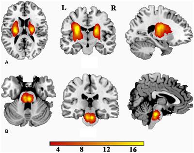 Dynamic brain activity states of memory impairment in stroke patients with varying motor outcomes